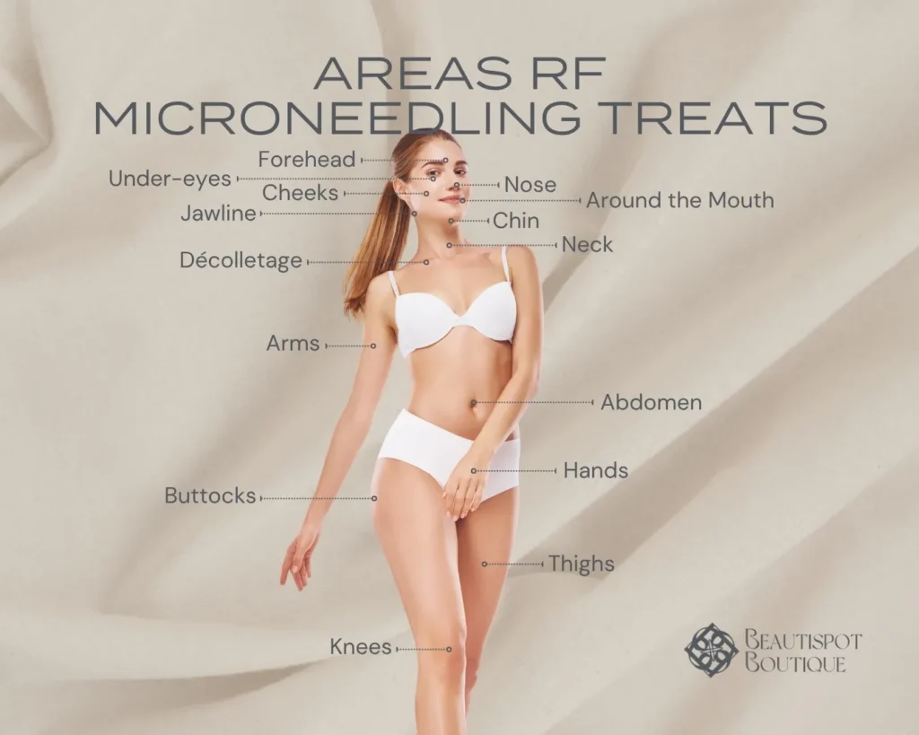 Graphic of woman pointing to areas that microneedling treats