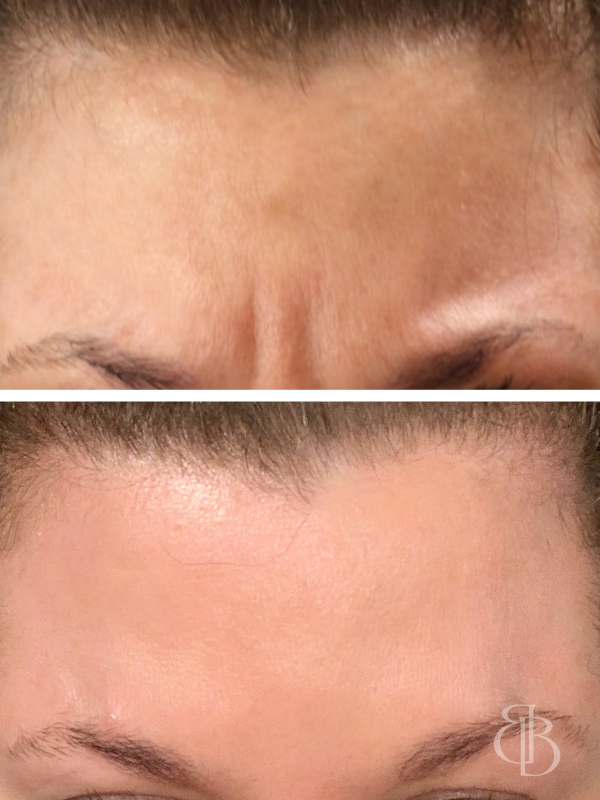 Botox 11s Before/After