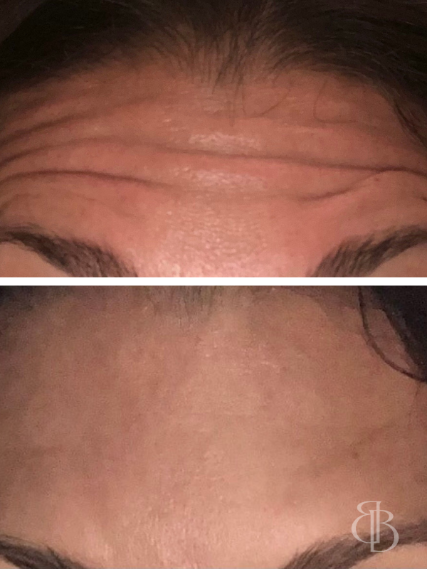 Botox Forehead Before/After 1