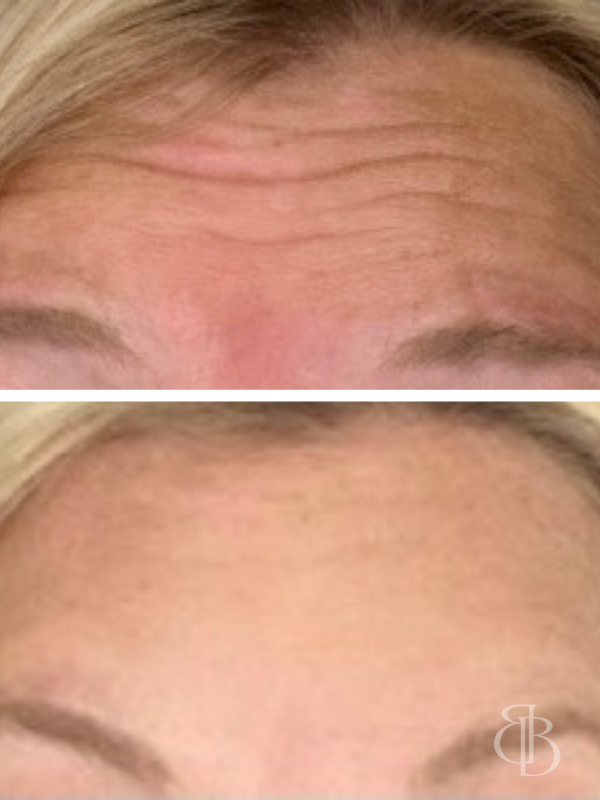 Botox Forehead Before/After 2
