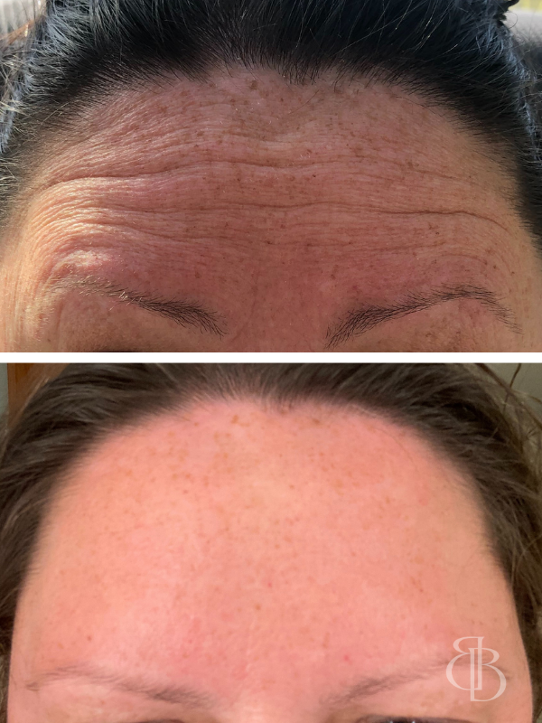 Botox Forehead Before/After 3