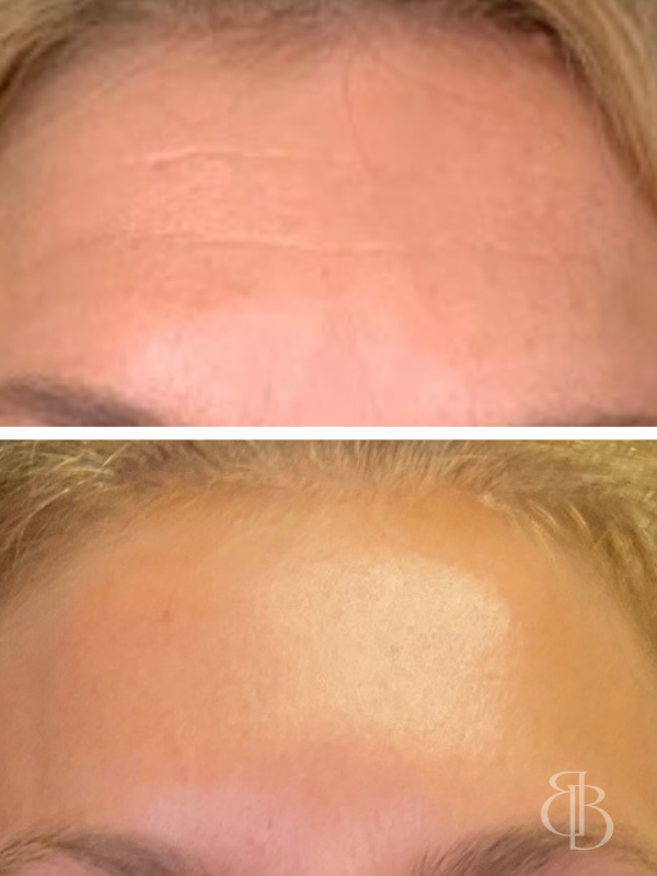 Botox Forehead Before/After 5