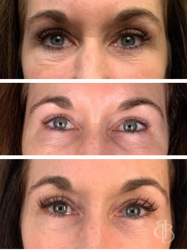 Cheek Filler Before/After 2