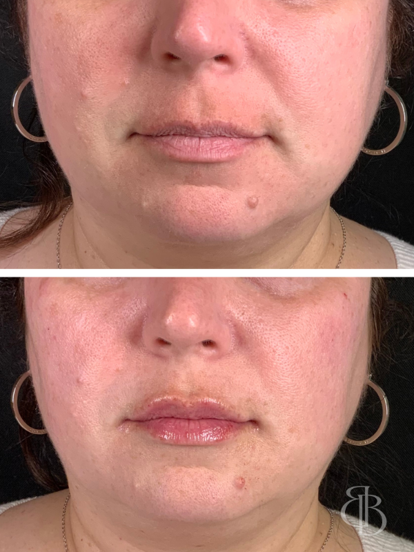 Lip Filler Before/After 5