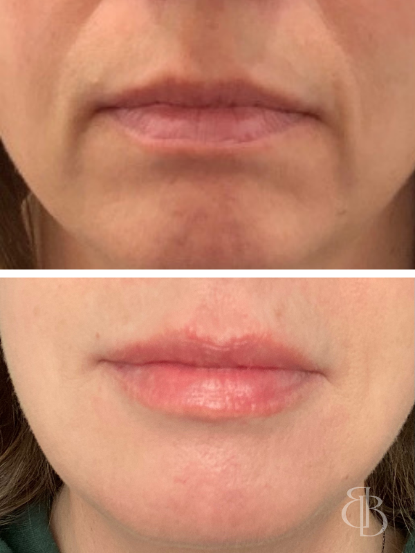 Lip Filler Before/After 1