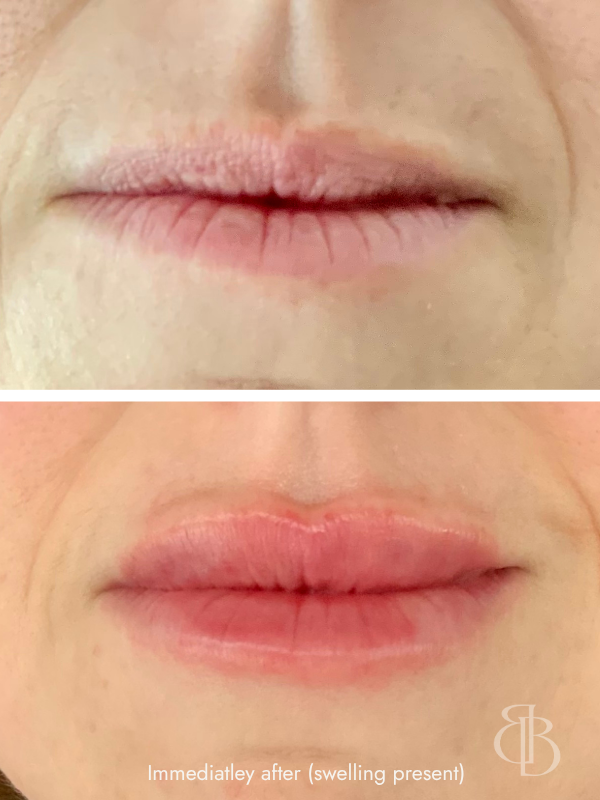 Lip Filler Before/After 2