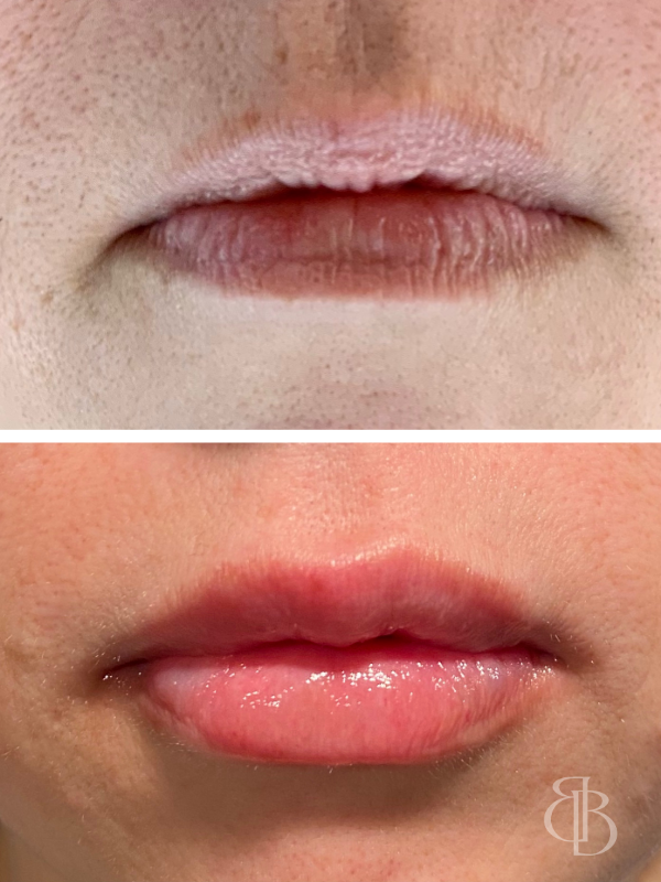 Lip Filler Before/After 3