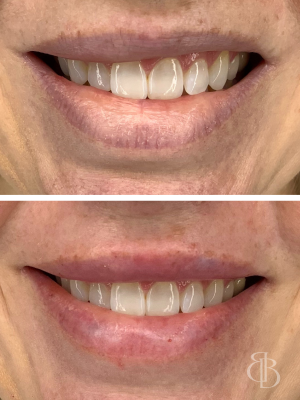 Lip Filler Before/After 4