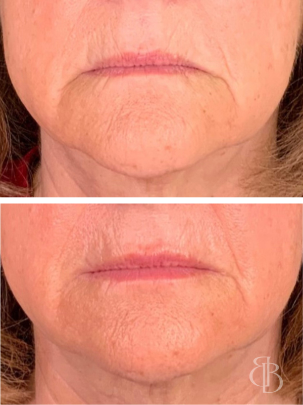 Lip Filler Before/After 6