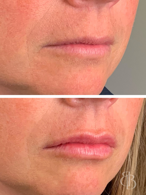 Lip Filler Before/After 7