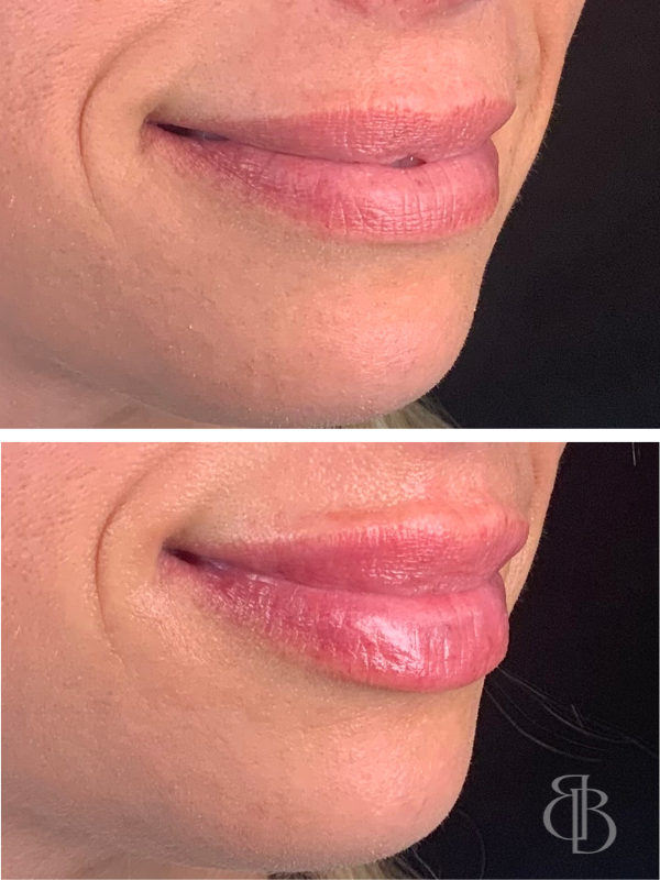 Lip Filler Before/After 8