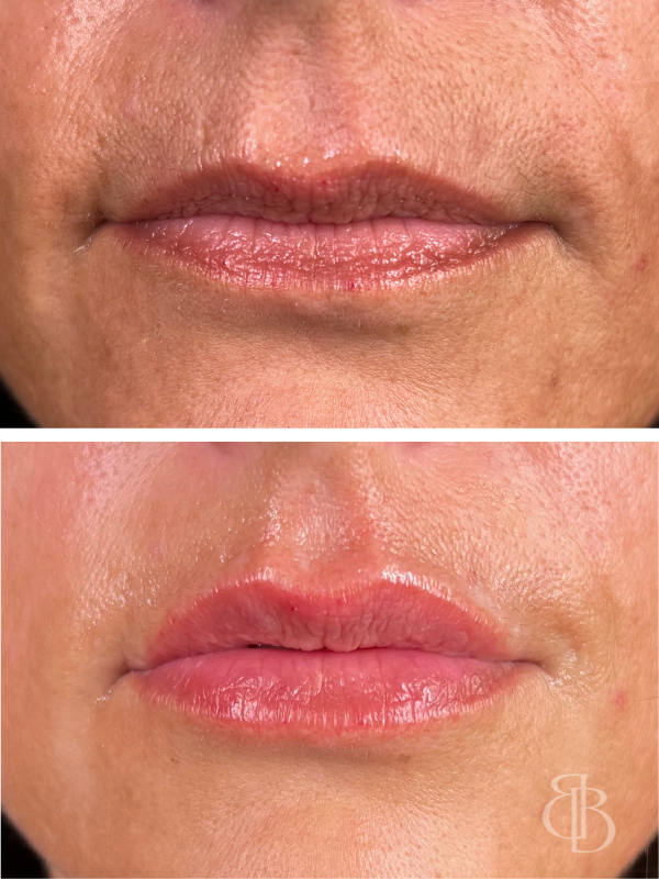 Lip Filler Before/After 9