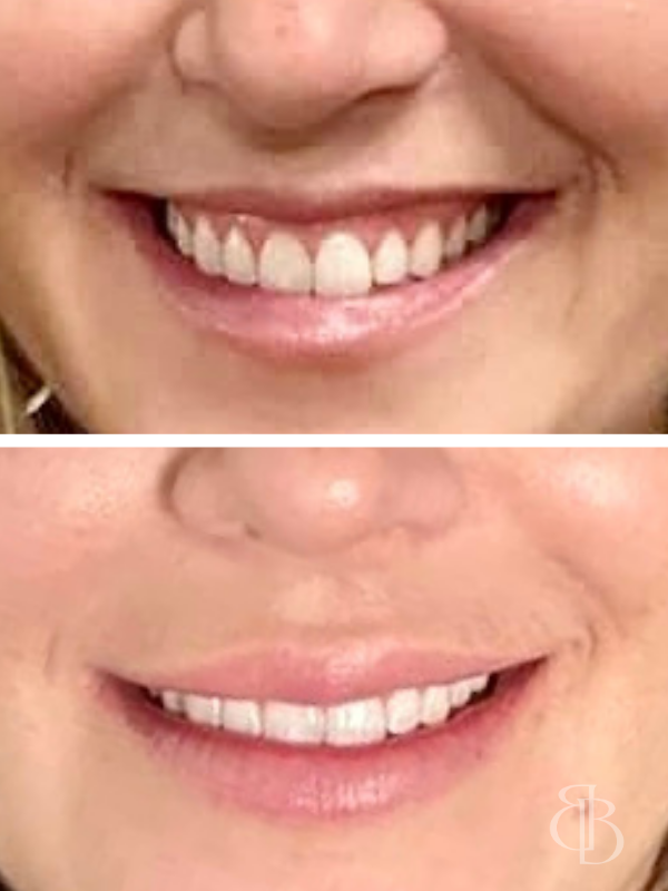 Lip Flip Before/After 1