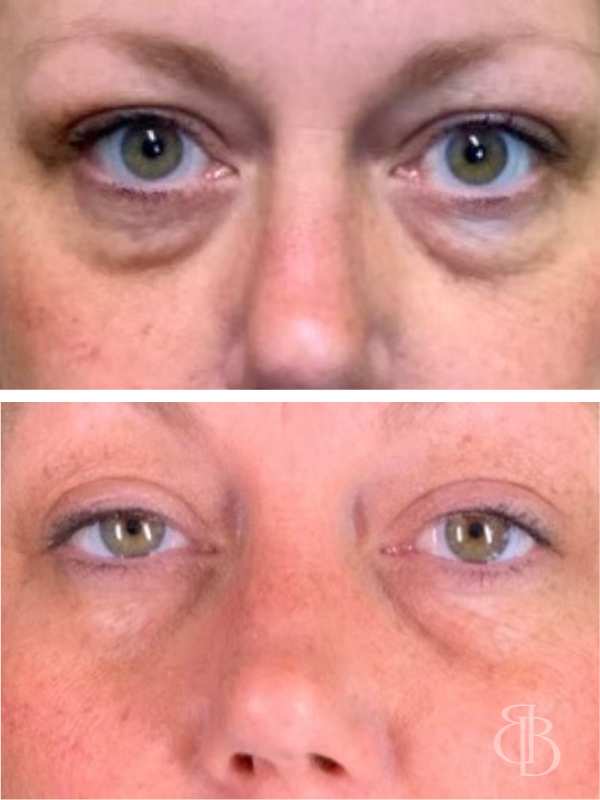 PRP Injections Before/After