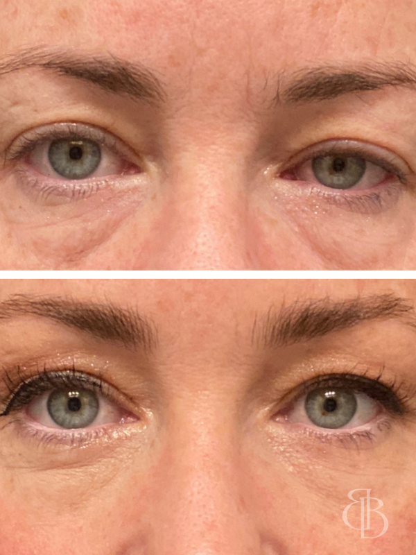 Upneeq Before/After