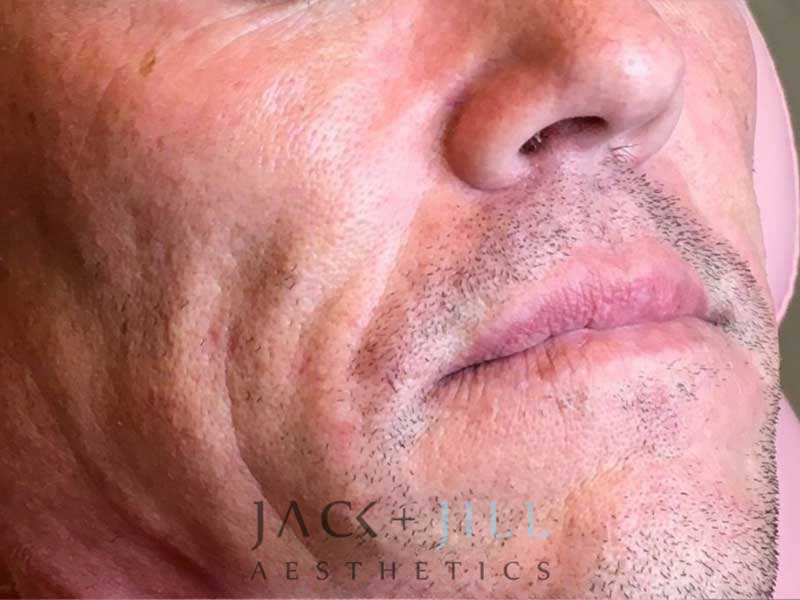 jack-jill-aesthetics-juvederm-voluma