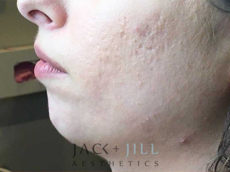 jack-jill-aesthetics-juvederm-voluma