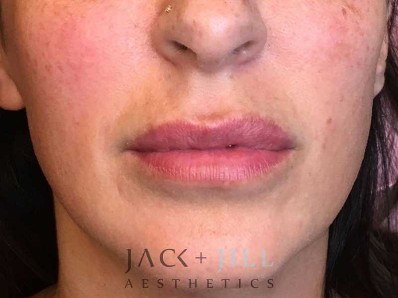 jack-jill-aesthetics-facial-fillers 3