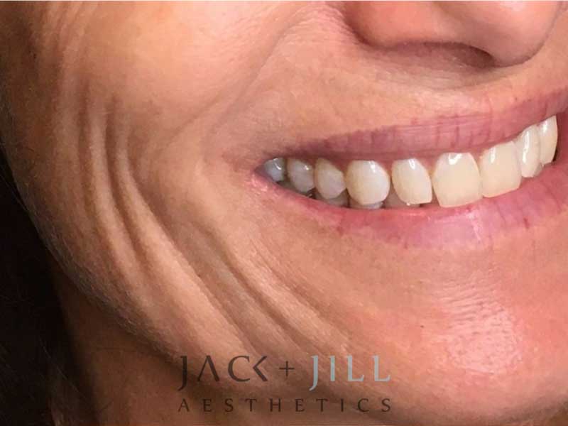 jack-jill-aesthetics-facial-fillers 2