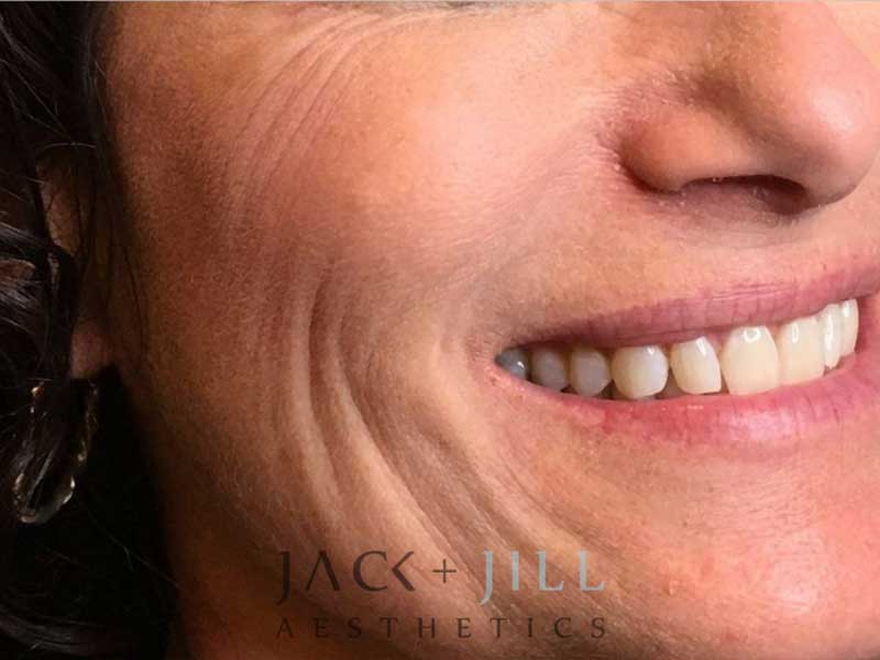 jack-jill-aesthetics-juvederm-voluma
