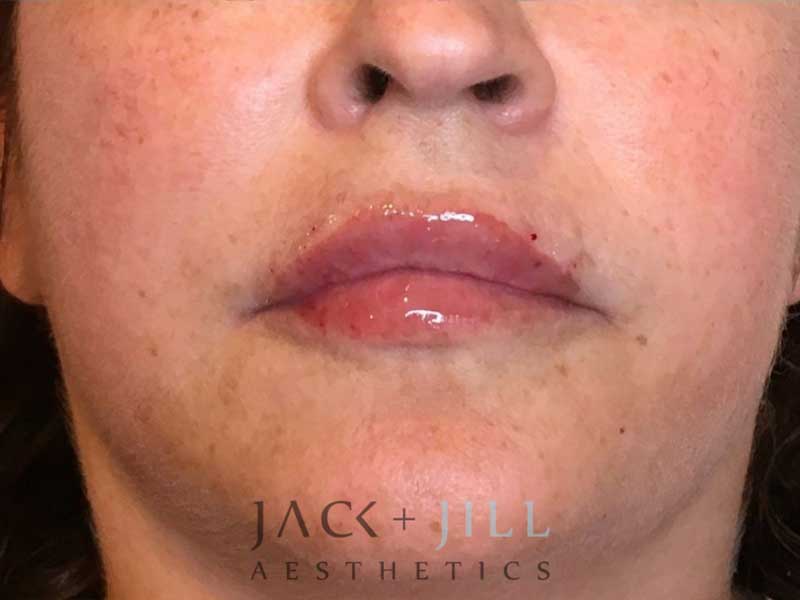 jack-jill-aesthetics-facial-fillers 2