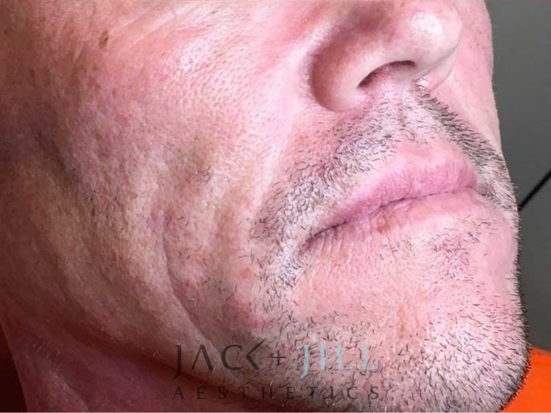 jack-jill-aesthetics-juvederm-voluma