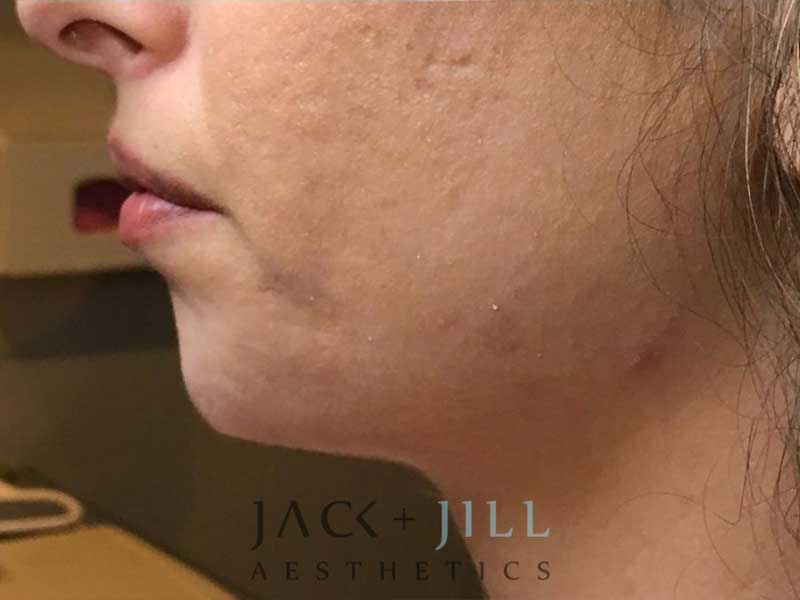 jack-jill-aesthetics-juvederm-voluma