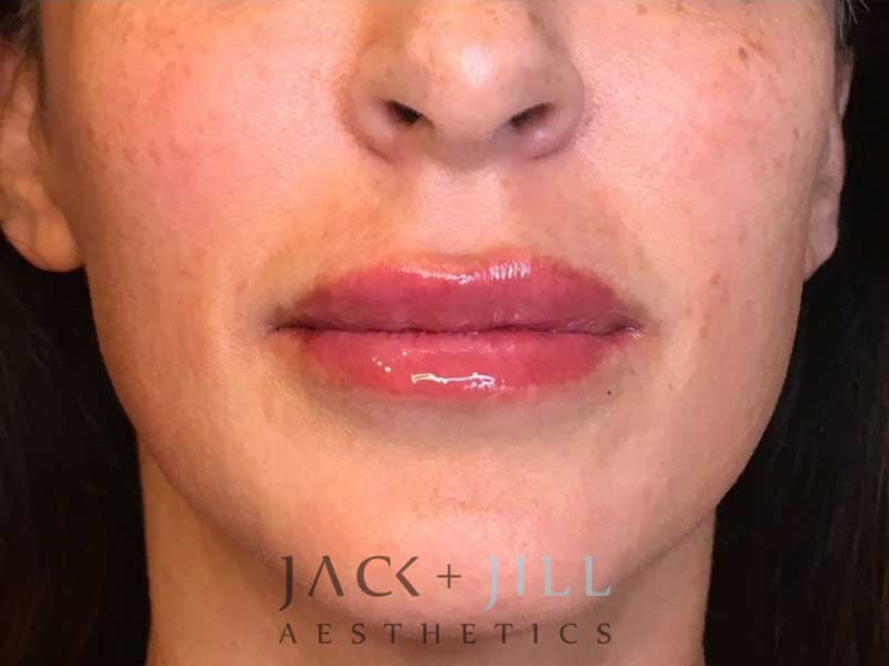 jack-jill-aesthetics-facial-fillers 3