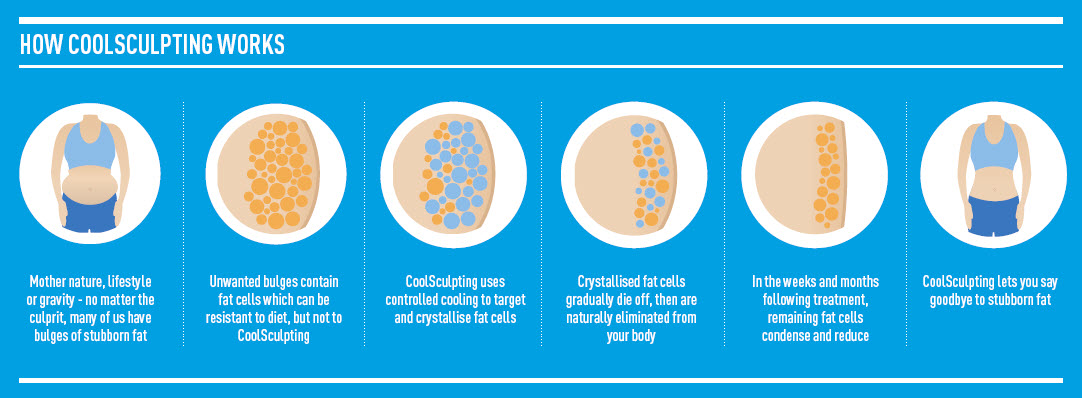 how-coolsculpting-works-1