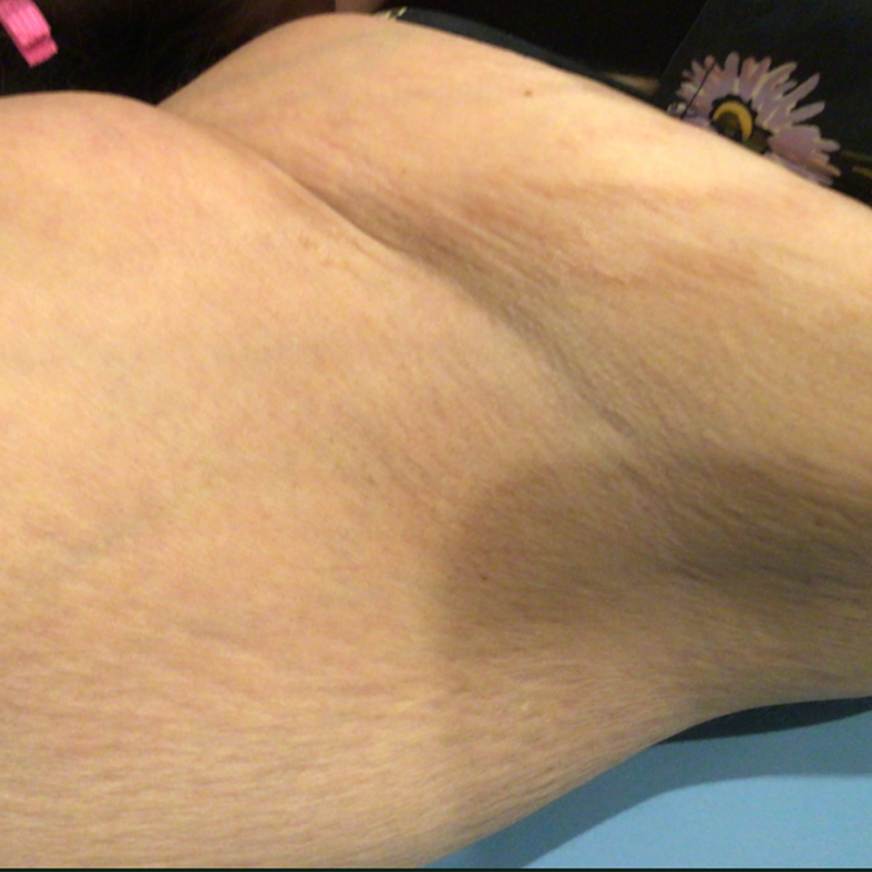 laser-hair-removal
