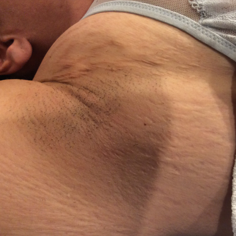 laser-hair-removal